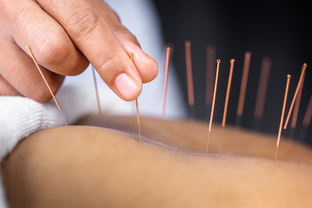 Acupuncture-Treatment-Bellevue